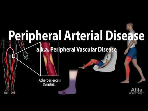 Peripheral Artery Disease — Buffalo Vascular Care