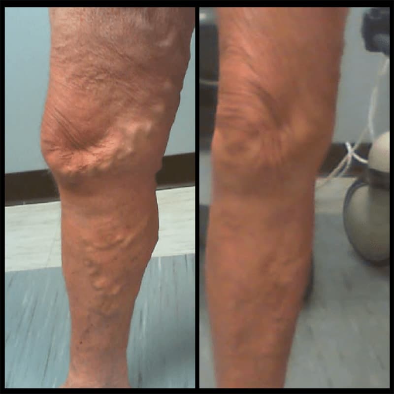 Buffalo Vascular Care patient result 2