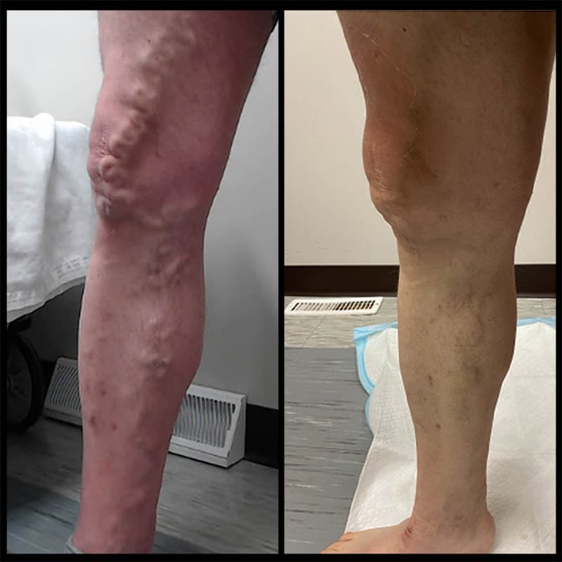 Buffalo Vascular Care patient result 3