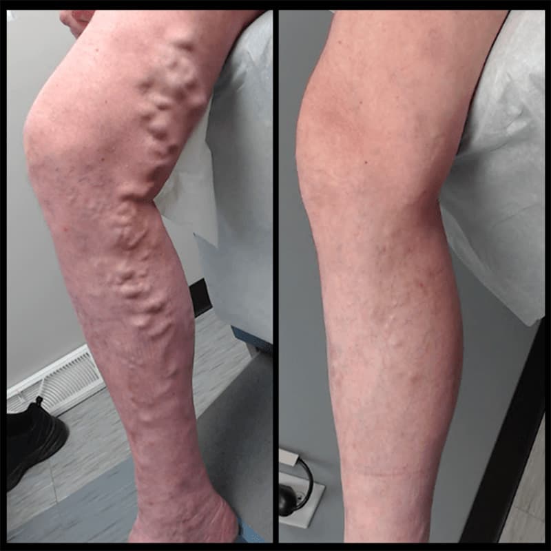 Buffalo Vascular Care patient result 4