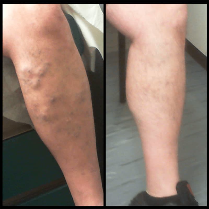 Buffalo Vascular Care patient result 6