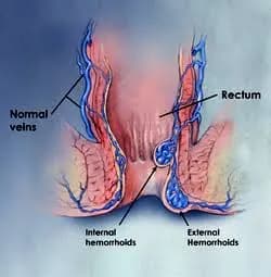 Illustration of rectal anatomy showing normal veins alongside internal and external hemorrhoids