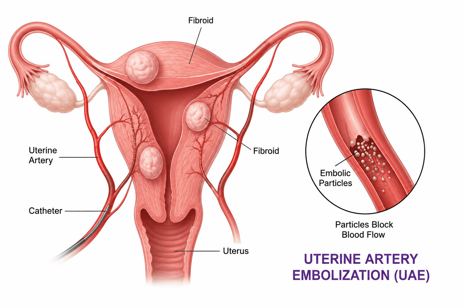 Uterine artery embolization procedure