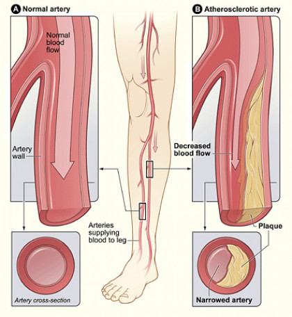 Peripheral Arterial Disease – Buffalo Vascular Care