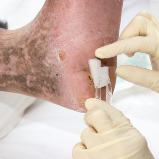 Wound care experts at Buffalo Vascular Care